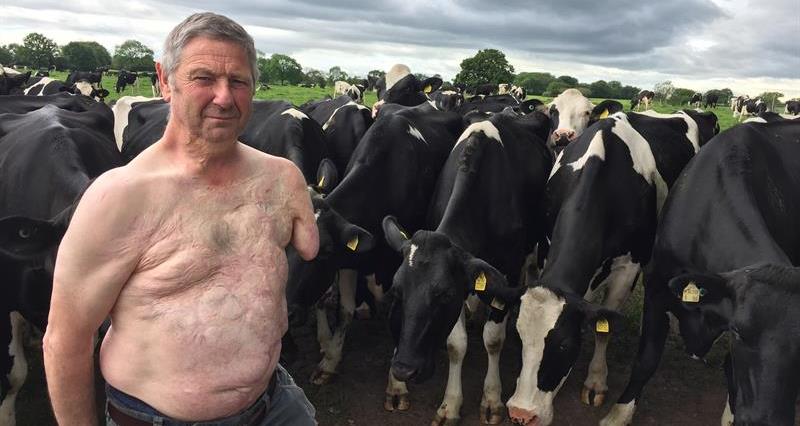 A photo of Kit Hopley that shows his injuries after his PTO accident. He is pictured on a farm behind a herd of cows.